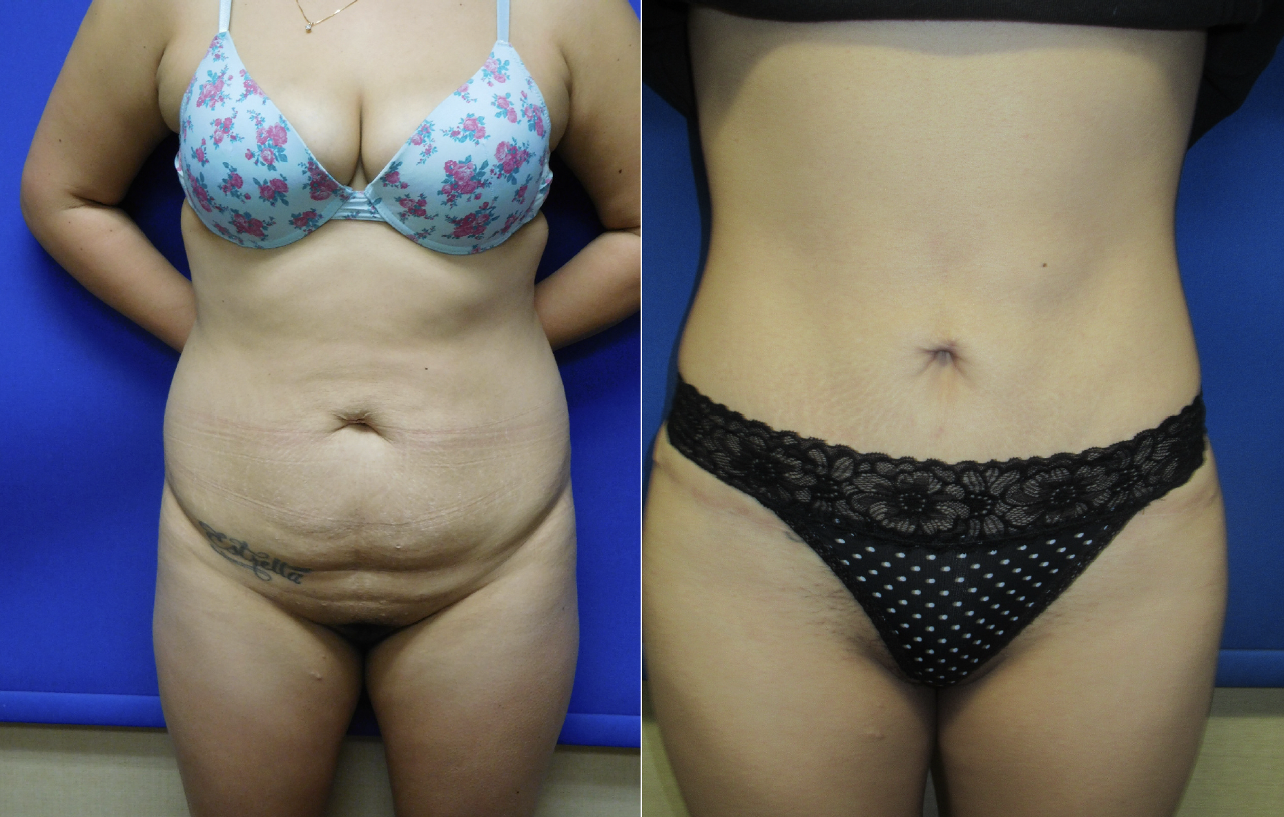 Tummy Tuck Before and After